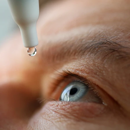 An eye, held open as eye drops are deposited into it