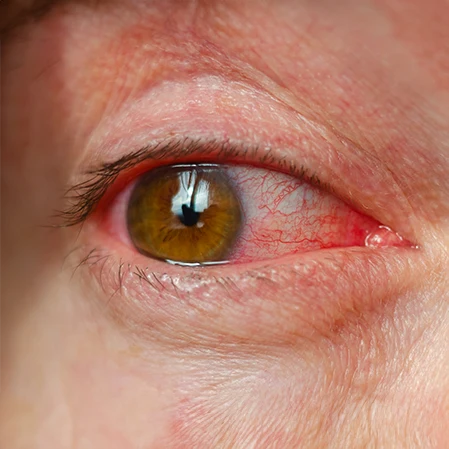An enflamed, red, and teary eye. The eye is irritated an in need of treatment.
